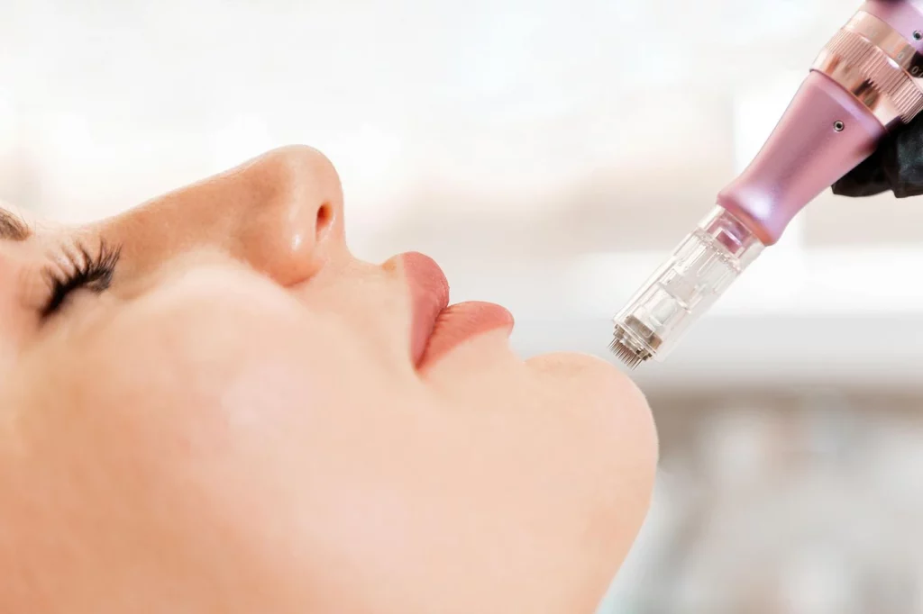 Beste Microneedling Pen van 2023: Verbeter je Huid met deze Top Keuzes